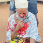 Protest Turns Violent: Woman Suffers Eye Injury Amid Clashes