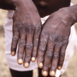 NPHIL Reports Four Mpox-Related Deaths 